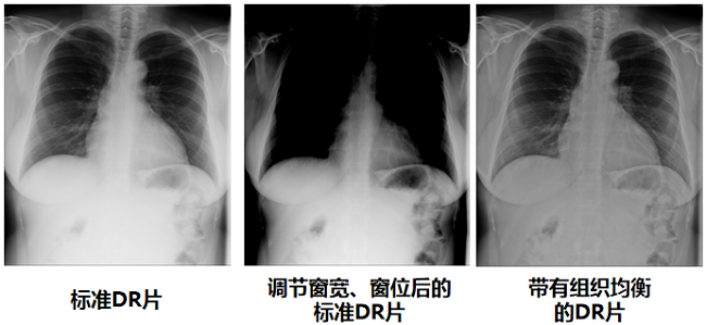 組織均衡技(ji)術(shù)讓DR圖像更清(qing)晰